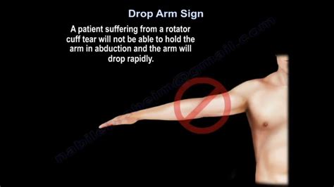 rotator cuff tests drop arm|positive drop arm sign.